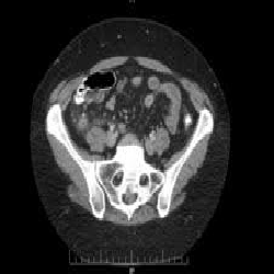 Stump Appendicitis